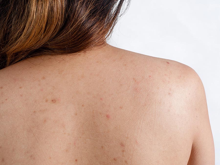 Tea Tree for Acne Treatment